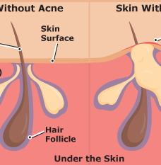 New Research: Acne is Caused by Inflammation