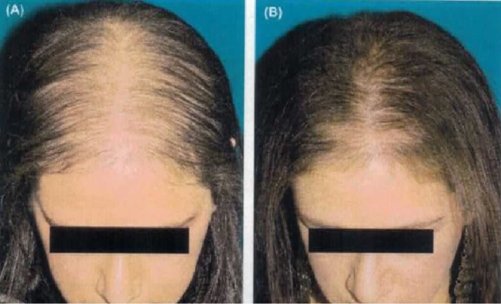 Vampire Hair Restoration Before & After