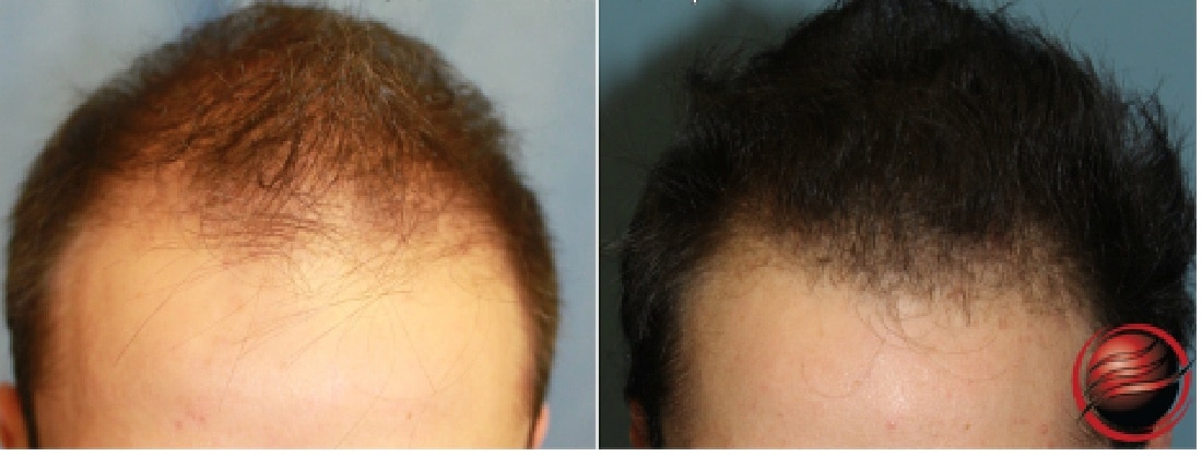 Vampire PRP Hair Restoration Before & After