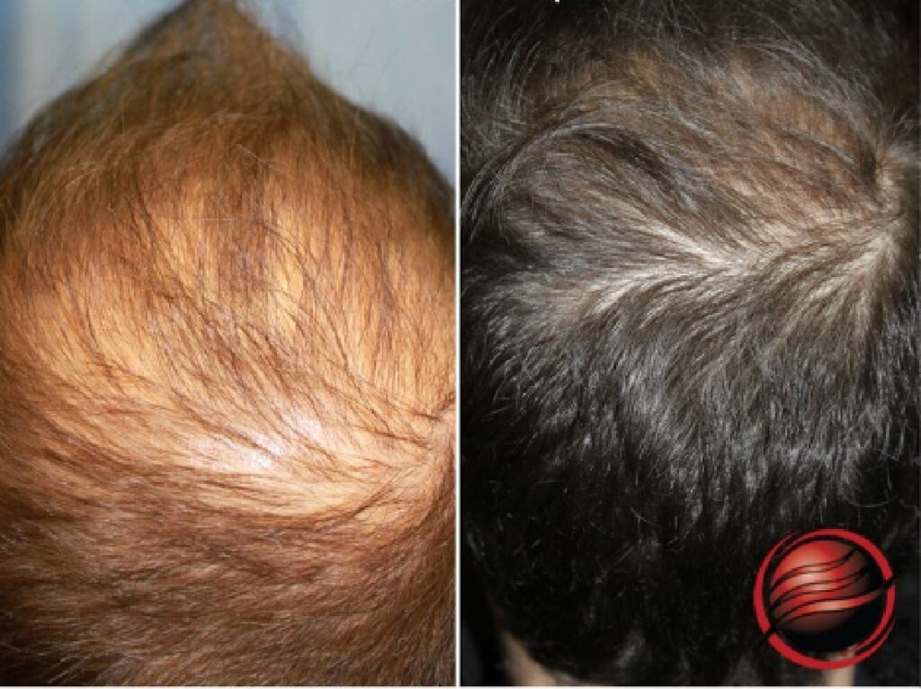 Vampire Hair Restoration Before & After