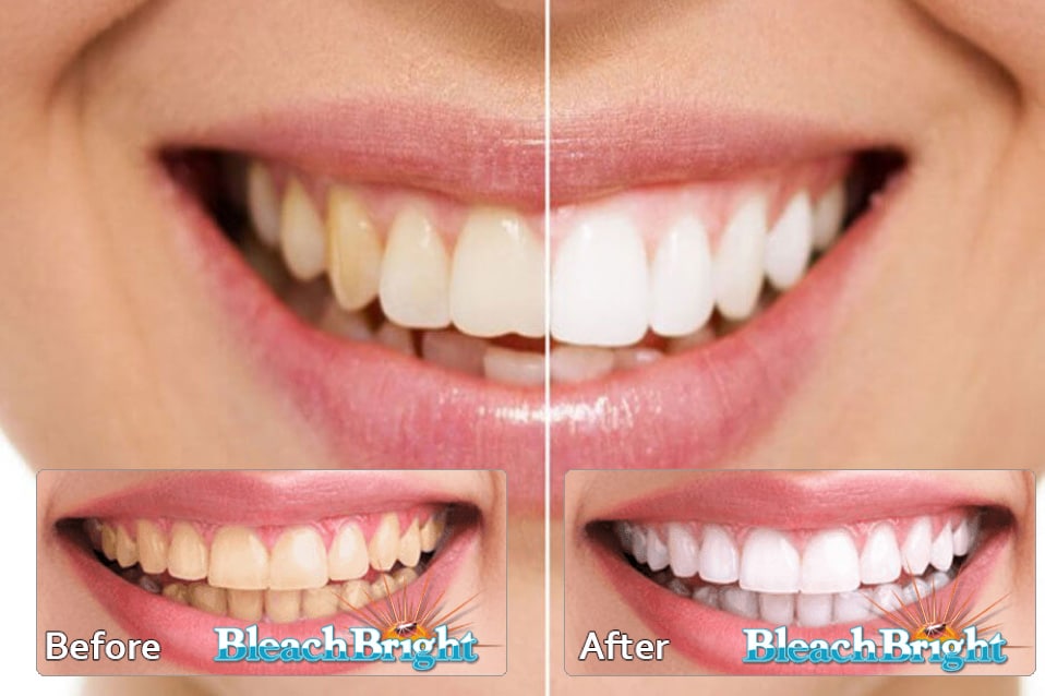 Teeth Whitening Service in Westfield NJ Bleach Bright Teeth Whitening