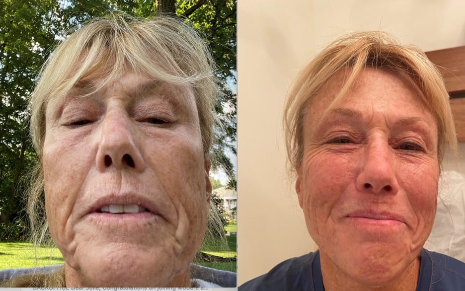Before And After Bioptron Light Therapy Image