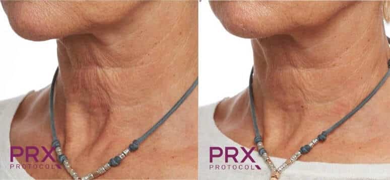 Before and After 2 PRX-t33 Treatments Image