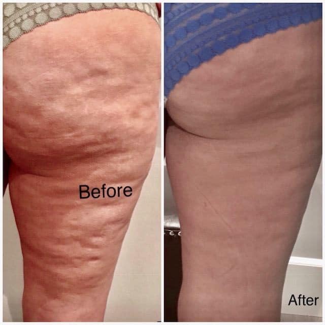 Before After Cellulite Red Light Therapy