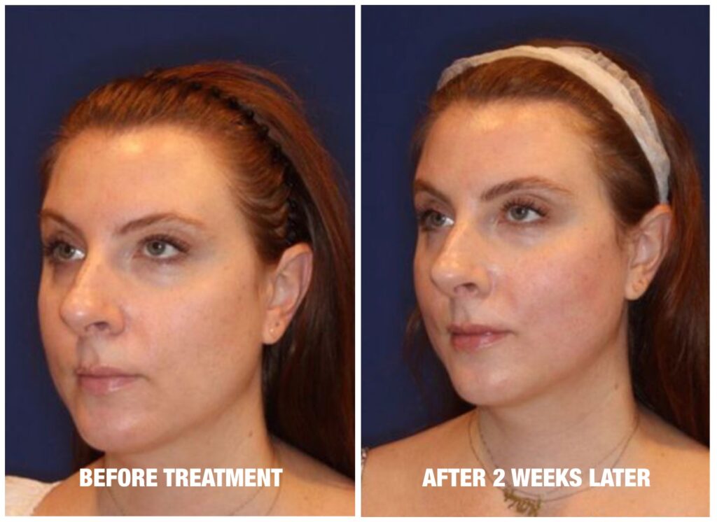 facework before after